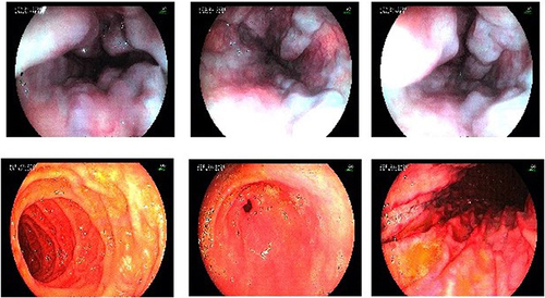 Figure 1 Upper GI endoscopy showing grade IV esophageal varices for patient 1 in March 2021.