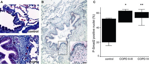 Figure 3 P-Smad2 positive nuclei in peribronchiolar lung. A. Representative Masson's Trichrome staining of control adult and COPD lungs. Collagen fibers stain blue. B. Representative P-Smad2 staining of a patient with stage II COPD. A small airway with peribronchiolar thickening and inflammation is shown. The positive nuclear staining is reddish-brown. Scale bar = 100 μ m. C. Quantification of P-Smad2 positive nuclei in the peribronchiolar area of small airways from the different patient groups. The results are presented as boxplots.*, p = 0.025;**, p = 0.01.