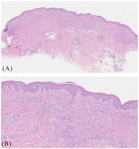 Figure 2. A skin biopsy showed hyperkeratosis, hickening of the epidermis, and a palisaded arrangement of epithelioid granulomas, with collagen egeneration (A, 20×; B, 40×).