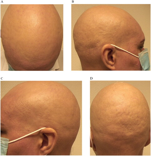 Figure 1. Clinical images at baseline (prior to treatment with upadacitinib).