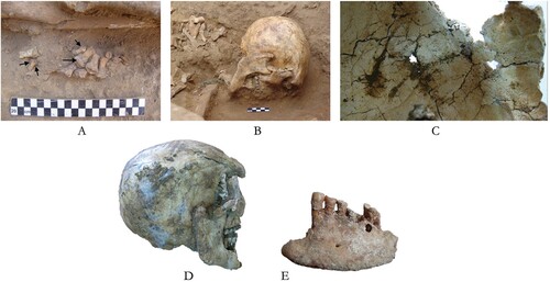 Figure 4. A) Traces of arthritis and severe osteophytic lipping on the edge of the vertebral body and foot phalanges (Tomb I). B–C) Cranial vault porosity (Tomb I). D–E) Calculus formation and a chalky appearance on the labial and buccal surfaces of the teeth (Tomb II; © S. Afshar).