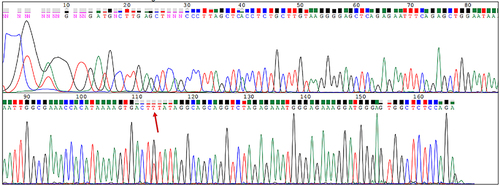 Figure 3 Sequencing results of the proband. The arrow points to the position of the SNP.