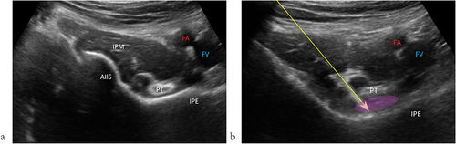 Figure 1 Sonoanatomy of PENG block. The ultrasonic anatomy of a PENG block (a); Ultrasound anatomy of PENG block after local anesthetic injection (b). Arrow, needle pathway; Area outlined by an ellipse, local anesthetic dissemination.