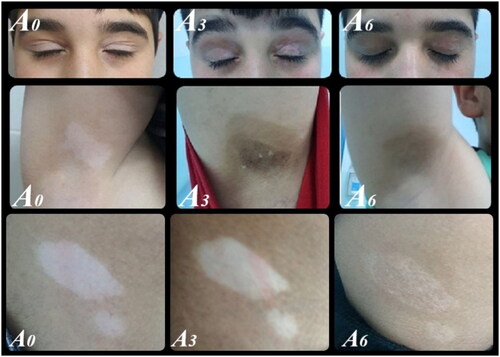 Figure 1. Improvement in repigmentation in group a across follow-up points.