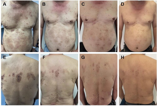 Figure 1. A, E: Clinical features of bullous pemphigoid lesions on the skin of a patient upon initial diagnosis (lesions covering over 40% of the body-surface area). B, F: following a two-week therapy regimen involving the administration of Dupilumab in conjunction with low-dose hormones, a notable reduction in the presence of lesions was seen (lesions covering 35% of the body-surface area). C, G: following a 4-week therapy protocol using only upadacitinib, a significant improvement in the condition of the skin lesions was noted (lesions covering 10% of the body-surface area)., with no occurrence of new lesions. D, H: following a sustained 10-week course of upadacitinib treatment, the regression of pre-existing lesions persisted (lesions covering < 5% of the body-surface area), with no new lesions observed.