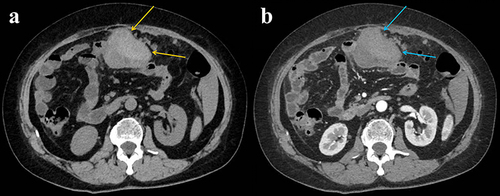 Figure 1 Abdominal computed tomography shows a slightly high-density heterogeneous mass of 9.3 * 5.9cm in the small intestine, with a density ranging from 34 to 57HU, indicated by yellow arrows (a). Enhanced scanning shows mild heterogeneous enhancement of the tumor, indicated by blue arrows (b).