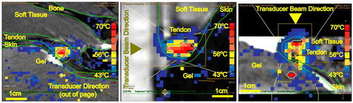 Figure 4. MRI image of the Achilles tendon with MR thermometry (PRFS-MRT) at the end of MRgFUS sonication showing the maximum temperature achieved for Group 2 A (900 J only). Temperature mapping corresponds to the scale displayed on the right for PRFS-MRT in (a) sagittal, (b) axial, and (c) coronal views. The white lines represent the sonication cone; the yellow lines represent the treatable sonication region.