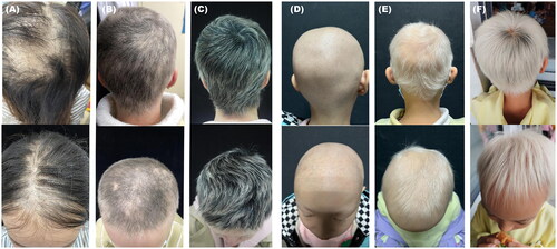 Figure 2. Scalp pictures of two patients. A-C show scalp hair at baseline, month 6, and month 9 visits in patient 1 on dupilumab. D-F show scalp hair at baseline, month 3, and month 9 visits in patient 7 on dupilumab.