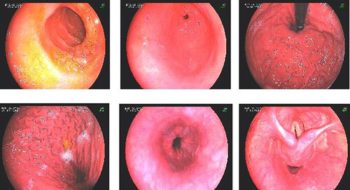 Figure 2 Follow up upper GI endoscopy for the same patient 1 done in April/2022 after proximal splenorenal shunt surgery, showing complete resolution of the esophageal varices.