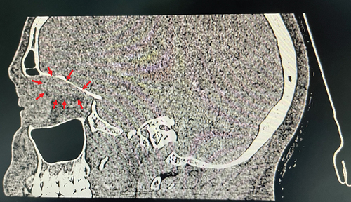Figure 2. Sagittal computed tomography scan showing a demarcated soft tissue density lesion in the right superior subperiosteal area.