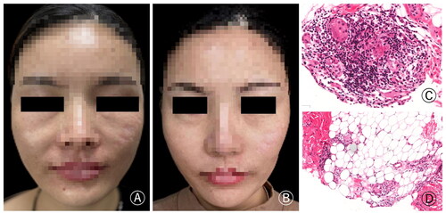 Figure 3. (A) The patient had swelling and nodules at the bilateral nasolabial fold. (B) The symptoms significantly improved after treatment. (C) The histopathology showed foreign body granuloma composed of more lymphocytes, macrophages and injected foreign bodies, and there was also inflammatory cell infiltrating around the adipose tissue (H&E × 200).