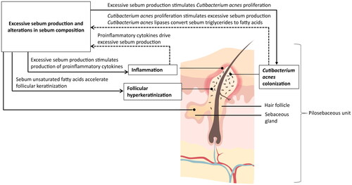 Figure 1. Contribution of sebum to acne pathophysiology. Acne pathophysiology is driven by 4 key factors: alteration in sebaceous immunobiology (excessive sebum production and alterations in sebum composition), inflammation, follicular hyperkeratinization, and colonization of Cutibacterium acnes (Citation6,Citation47,Citation48). Solid lines indicate an impact of sebum on the other 3 acne pathogenic factors, whereas dashed lines indicate the inverse.