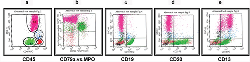 Figure 6. Biphenotypic acute leukemia (BAL). The blasts (green) were gated on CD45 versus SSC dot plot (a). Shown is the expression of cyCd79a versus MPO (b), CD19 (c), CD20 (d) and the myeloid-specific antigen of CD13 (e).