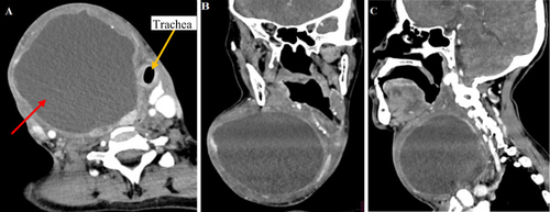 Figure 4 Head and neck post-contrast CT scan of the patient. (A) axial view of a huge thyroid abscess more on the right side as depicted by the red arrow; (B) coronal view of the same lesion causing lateral compression of the trachea and esophagus; (C) sagittal view of the same lesion.