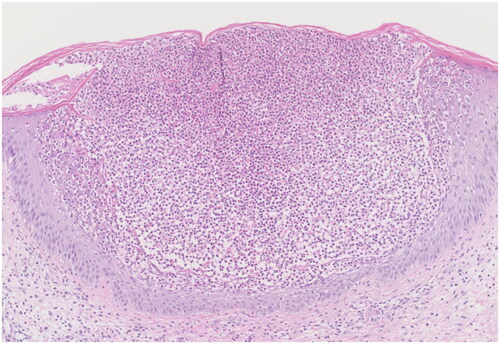 Figure 2. A histopathological examination of a punch biopsy specimen from the arm shows subcorneal pustules with epidermal spongiosis (hematoxylin-eosin; original magnification ×100).
