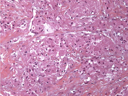 Figure 1. Benign form of Abrikossoff tumour: roundly granular and eosinophilic cytoplasm cells without atypia or mitosis activity (hemalun-eosin-safran colouration, growth × 200).