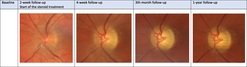 Figure 3 Evaluation of the optic nerve disc appearance of a patient with myelin oligodendrocyte glycoprotein (MOG) antibody-associated optic neuritis during 1-year follow-up.