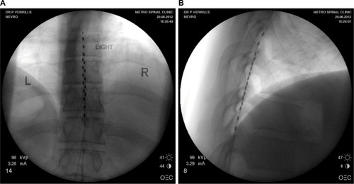 Figure 1 (A) Posterior anterior fluoroscopy image and (B) lateral fluoroscopy image of T8-T10 placement of linear leads (Nevro Corp.) for the treatment of chronic back and leg pain.