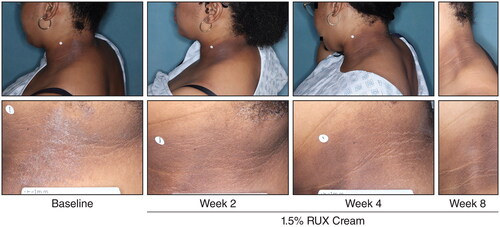 Figure 6. Representative clinical photographs of AD lesions in the head and neck region. AD: atopic dermatitis; RUX: ruxolitinib.