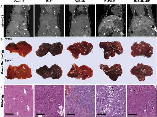 Figure 2 Liver tumor development was monitored using several methods. (A) Representative micro-CT images of mouse livers at 48 weeks on control, D+P, D+P+Hx, D+P+HF, and D+P+Hx+HF mice are shown. (B) The mice were euthanized at 48 weeks and the livers harvested. Pictures of gross morphology of the livers, front and back are shown for representative mice from each group. Dashed circles indicate grossly observed liver abnormalities >3mm. White arrows point to abnormalities <3mm in size. (C) A portion of the liver shown in panel B was fixed, embedded, and stained with hematoxylin and eosin (H&E). Images of stained sections from the liver of representative mice from each of the groups are shown. Magnification is 10x, and the scale bar represents 300 µm. Black arrowheads show macro- and microvesicular fatty change. Black arrows show diffused hyperplasia lipofuscin-laden kupffer cells.