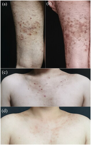 Figure 1. (a,c) Clinical manifestation before treatment with tofacitinib. Multiple papules and macules on forechest and left lower limb, with most of them breaking and crusting at the top. (b,d) Clinical manifestation after treatment with upacitinib. The papules have almost faded, leaving significant hyperpigmentation.