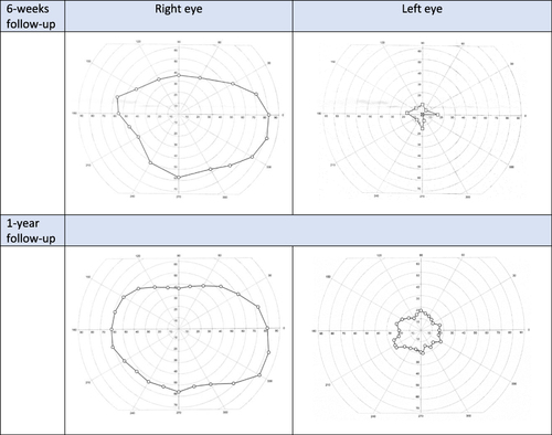 Figure 4 Evaluation of visual field of a patient with myelin oligodendrocyte glycoprotein (MOG) antibody-associated optic neuritis in the left eye during 1-year follow-up.