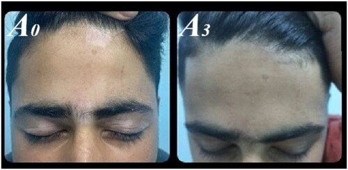 Figure 2. Excellent improvement after 3 months of treatment in group A.