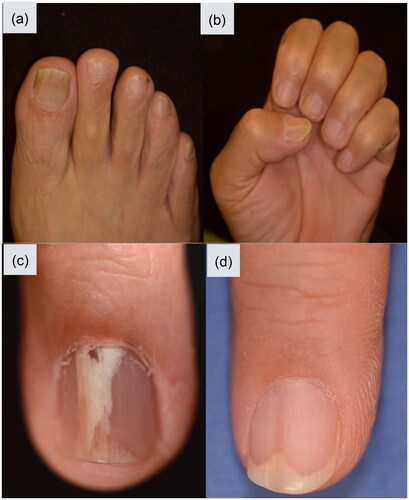Figure 2. Clinical features of onychopapilloma. (a) The photos were taken of a 55-year-old man who presented with a five-year history of various nail abnormalities affecting both his fingernails and toenails. These abnormalities included multiple longitudinal leukonychia with distal subungual hyperkeratosis as well as focal onycholysis and splinter hemorrhage. (b) The fingernails showed multiple longitudinal leukonychia of the previous patient. (c) A solitary onychopapilloma presented wide longitudinal leukonychia with distal onycholysis and splinter hemorrhage on the ring finger. (d) A solitary onychopapilloma presented longitudinal erythronychia with distal onycholysis on the middle finger.