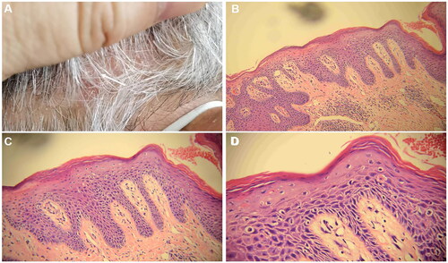 Figure 4. Histopathological findings of scalp psoriasis lesions (hematoxylin-eosin staining was utilized for histopathology). A. The samples were obtained from cutaneous lesions on the scalp that exhibited erythema and scaling. B, C, D: a small number of lymphocytes encircle the blood vessels in the superficial dermis, where hyperkeratosis and parakeratosis of the epidermis are observed, along with clubbing hyperplasia of the epidermis, neutrophil infiltration, thinning of the granular layer, and regular thickening of the spinous layer. The magnification factors for B, C, and D are 10×, 20×, and 40×, respectively.