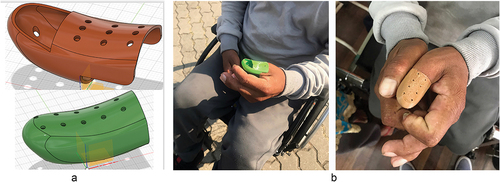 Figure 4. The two prototypes of the ‘finger’ for KS designed by S.M. Shrestha (a) and the patient wearing the two prototypes (b). Photo: S.M. Shrestha 2023.