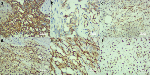 Figure 4 Immunohistochemical staining showed that tumor cells expressed CD31(a), CD34(b), Fli-1(c), MDM2(d), ERG(e), and INI1(f).