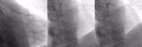 Figure 1 Coronary angiography.