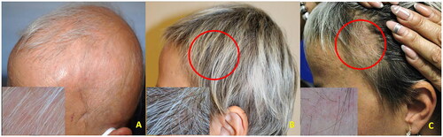 Figure 3. A (baseline): clinical aspect and dermoscopy (insert) of severe AA (SALT = 90); B (five months): regrowth under baricitinib treatment (4 mg/day); C (six months): relapse within the regrowth area (circle) while under baricitinib (Phenotype 1).