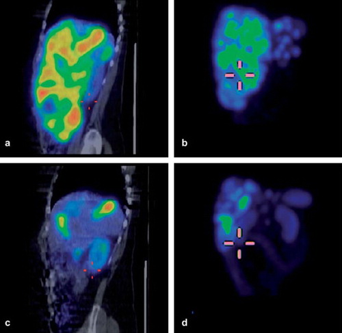 Figure 3. Example of change in tumor volume (liver metastases, hair cross on caudal pole of right kidney) during therapy in patient no. 8 (rectal carcinoid). SPECT/CT images 24 h after cycle 1 (a, b) and 6 (c, d); (a, c: fused sagittal views) b, d: maximum intensity projections.