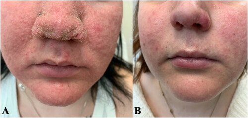 Figure 1. Trichodysplasia spinulosa. (A) Widespread erythematous papules with hyperkeratinized spicules distributed on the nose and central face, with concurrent acne vulgaris. (B) Resolution of TS-associated rash following four weeks of topical 1% cidofovir therapy.