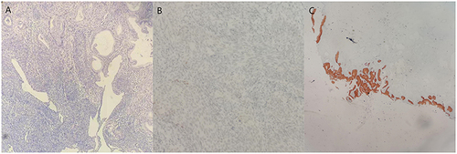 Figure 4 Immunohistochemical staining of squamous cell carcinoma (A) A high-grade squamous intraepithelial lesion and microinvasive squamous cell carcinoma were found on the cervix. (B) P53 was the wild type. (C) Immunohistochemical staining was positive for P16 in squamous cell carcinoma and negative in GAS.