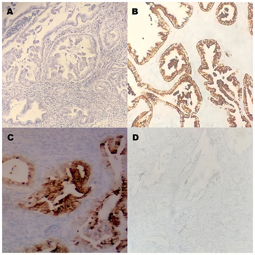 Figure 3 Immunohistochemical staining of GAS. Histologic ((A) hematoxylin and eosin staining) and immunohistochemical (B–D) findings. (A) The tumor shows gastric-type differentiation with abundant clear or pale, eosinophilic cytoplasm with atypical nuclei. (B and C) Immunohistochemical staining for MUC6 and CEA was positive. (D) P53, wild type.