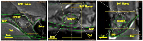 Figure 2. T2-weighted MRI image of the Achilles tendon used in treatment planning of MRgFUS sonication. Treatment target is verified in the (a) sagittal, (b) axial, and (c) coronal views.