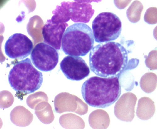 Figure 1. May-Grunwald Giemsa (MG) of the bone marrow smear preparation. BPDCN malignant cells have high nucleuscytoplasm ratio with nucleus displaying a moderately dispersed chromatin and inconspicuous nucleoli. The cytoplasm exhibited dense basophilia and the presence of microvacuoles in some cells.