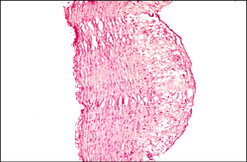 Figure 2 Hyperlipidemic control (group 2): Microphotograph of thoracic aorta exhibiting atherosclerotic lesions with formation of plaque, thickened intima containing foam cells, and extracellular lipid (× 100, HE).