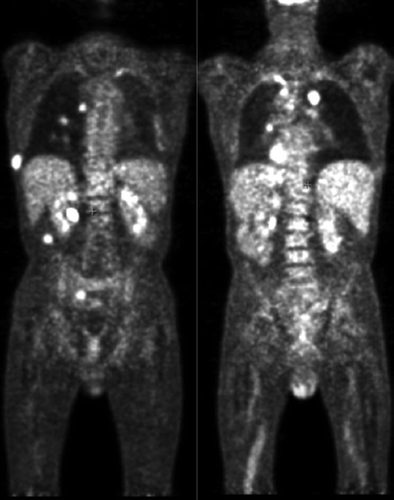 Figure 4. 18-Fluoro-deoxy-glucose positron emission tomography: multiple hypermetabolic hotspots (on those slides: bilateral nodular lung, pleural sus-diaphragmatic node, retro-peritoneal nodule under the right renal loge, pleura).