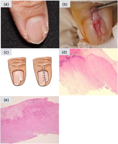 Figure 1. The longitudinal excision of the onychopapilloma and histological characteristics. (a) There is longitudinal leukonychia with onycholysis and distal fissuring on the right thumb. (b) Following the avulsion of the nail plate, the onychopapilloma was exposed on the nail bed, and we removed it via longitudinal excision. And the defect was closed with a non-absorbable thread. (c) The schematic diagram of the surgical procedure. The left side shows a presurgical nail lesion. The right side demonstrates the surgical outcome with suturing over the proximal nail fold and nail plate. (d) Papillomatosis and acanthosis of the nail bed, distal subungual hyperkeratosis with parakeratosis. (e) Matrix metaplasia with abundant eosinophilic cytoplasm in the upper part of nail bed epithelium.