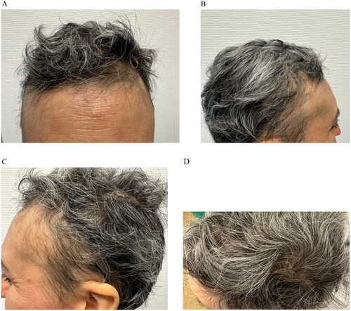 Figure 2. Clinical images after five months of treatment with upadacitinib 30 mg/day.
