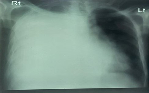 Figure 1 Right lung opacity with right Costo-phrenic angle distortion and air fluid level at the tip of the right lung (suggestive of empyema and lung abscess).