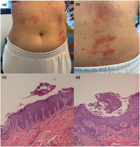 Figure 1. Erythematous plaques covered by multiple pustules in a 33-year-old female (Figure 1(a,b)). Histopathological picture of an incisional biopsy from a plaque on the back. Section of the skin characterized by epidermal hyperplasia, orto-parakeratosis, mixed inflammatory infiltrate in the dermis (Figure 1(c)), and micro pustules (Figure 1(d)). (c) Hematoxylin and Eosin stain, ×10 magnification; (d) Hematoxylin and Eosin stain, ×20 magnification