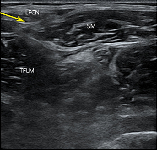 Figure 2 Sonoanatomy of LFCN block. The needle tip was inserted into the fascia tunnel produced by the sartorius and tensor fascia lata. Arrow, needle pathway.