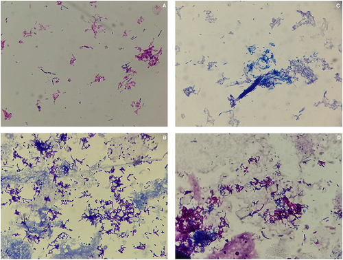 Figure 2 Microscopic morphological characteristics of smear staining (magnification: 1000×): Gram staining (A), Wright-Giemsa staining (B), Ziehl-Neelsen staining (C), modified Ziehl-Neelsen staining (D).