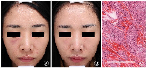 Figure 1. (A) Nodules and swelling developed in the bilateral infraorbital region, particularly on the right side. (B) The symptoms were significantly relieved after treatment. (C) Foreign bodies were observed dispersed among inflammatory cells, epithelioid cells, and macrophages. Additionally, multinucleated foreign body giant cells were also observed (H&E × 200).