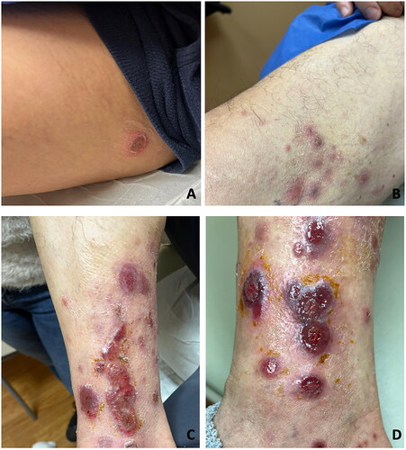 Figure 1. Pink firm nodules, round crusted plaques, erosions with violaceous rim at initial presentation (A–C) and 2 weeks after initial presentation (D). A) Right groin. B) Right thigh. C) Right medial ankle. D) Right medial ankle.