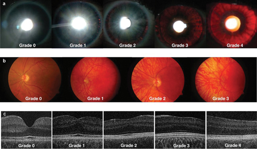 Figure 1. Staging schemes in albinism. Iris transillumination. Anterior segment photos in albinism show various degrees of iris transillumination according to the grading scheme by Summers et al. [Citation17]. Adapted and reprinted with permission from Papageorgiou et al [Citation18].